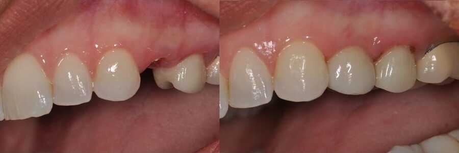 имплантация зубов фото до и после - в Краматорске