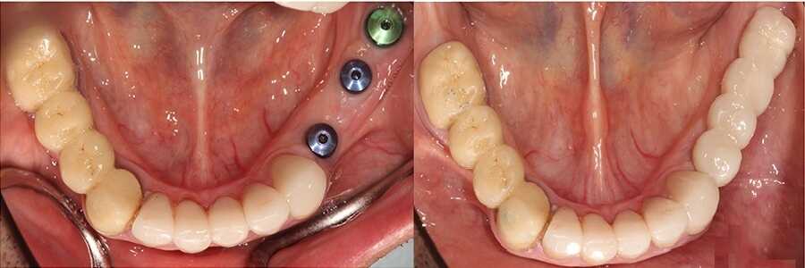 импланты зубов фото до и после - в Краматорске