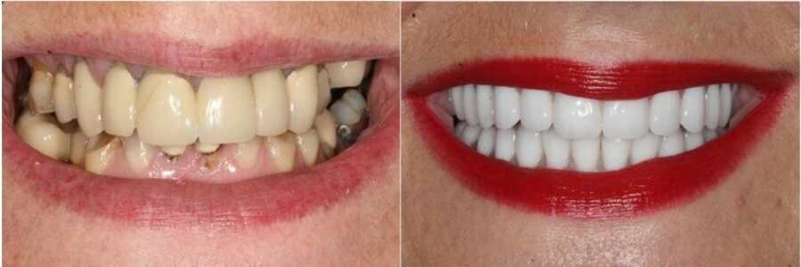импланты зубы фото до и после - в Краматорске