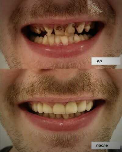 зубные коронки из циркония фото