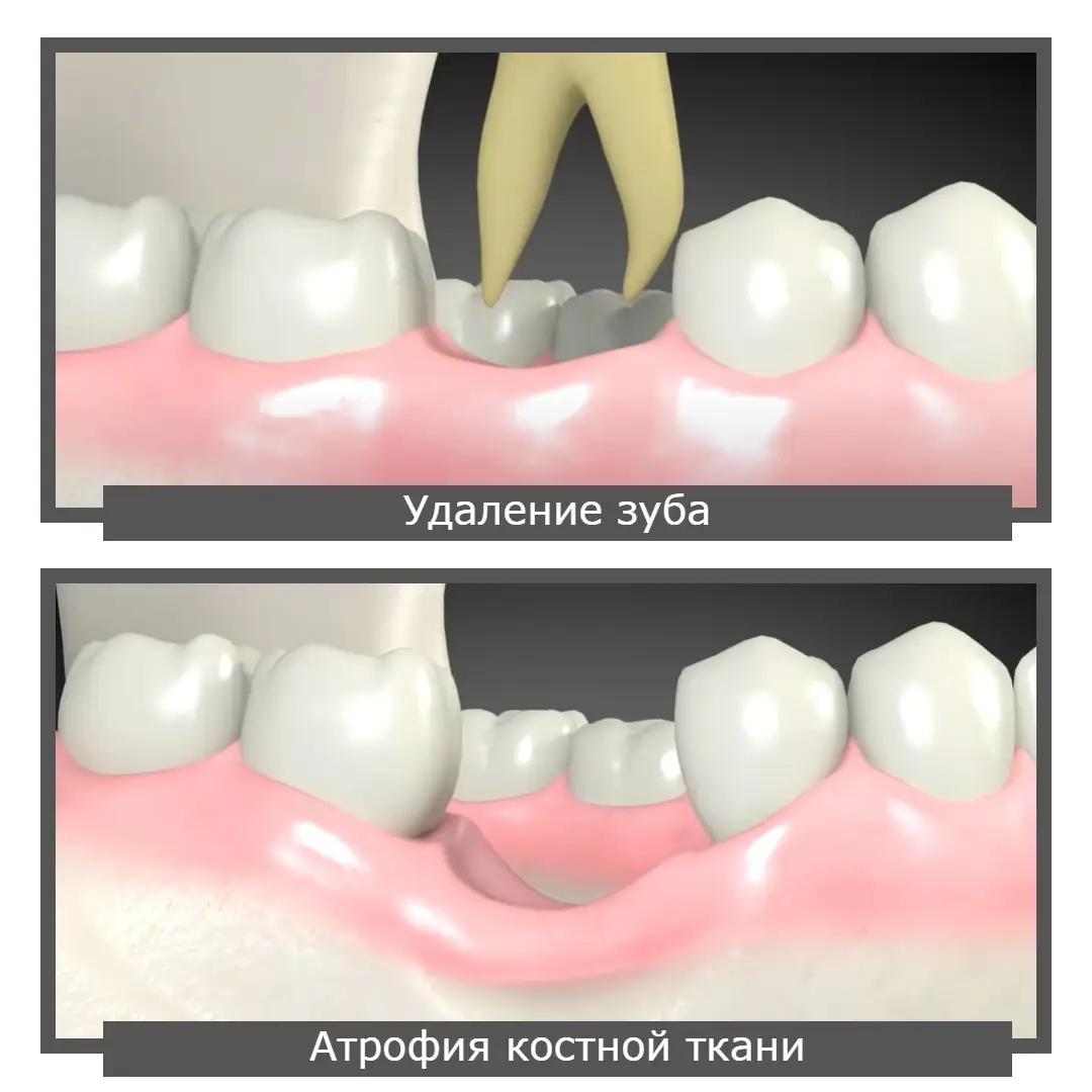 наращивание костной ткани в стоматологии - Краматорск | Днепре