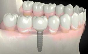 регенерация костной ткани зуба проводиться одновременно с имплантацией зубов