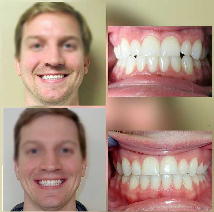 брекеты для зубов фото до и после